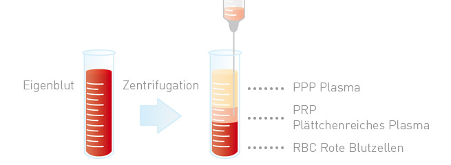 Zentrifugation bei der PRP Eigenblut-Therapie